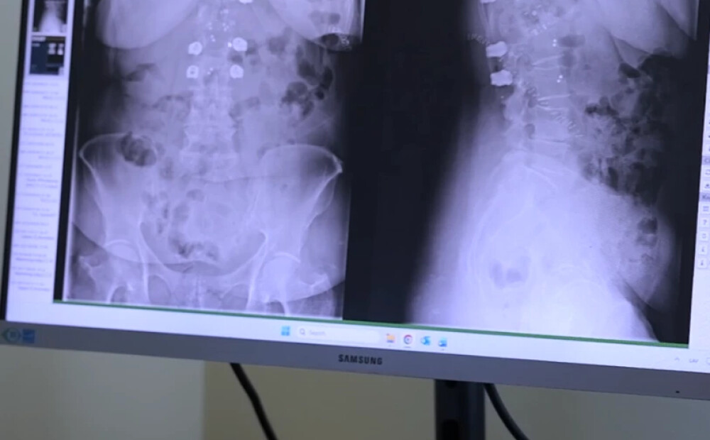 Sarežģīta operācija Ziemeļkurzemes reģionālajā slimnīcā primārajam mugurkaula audzējam